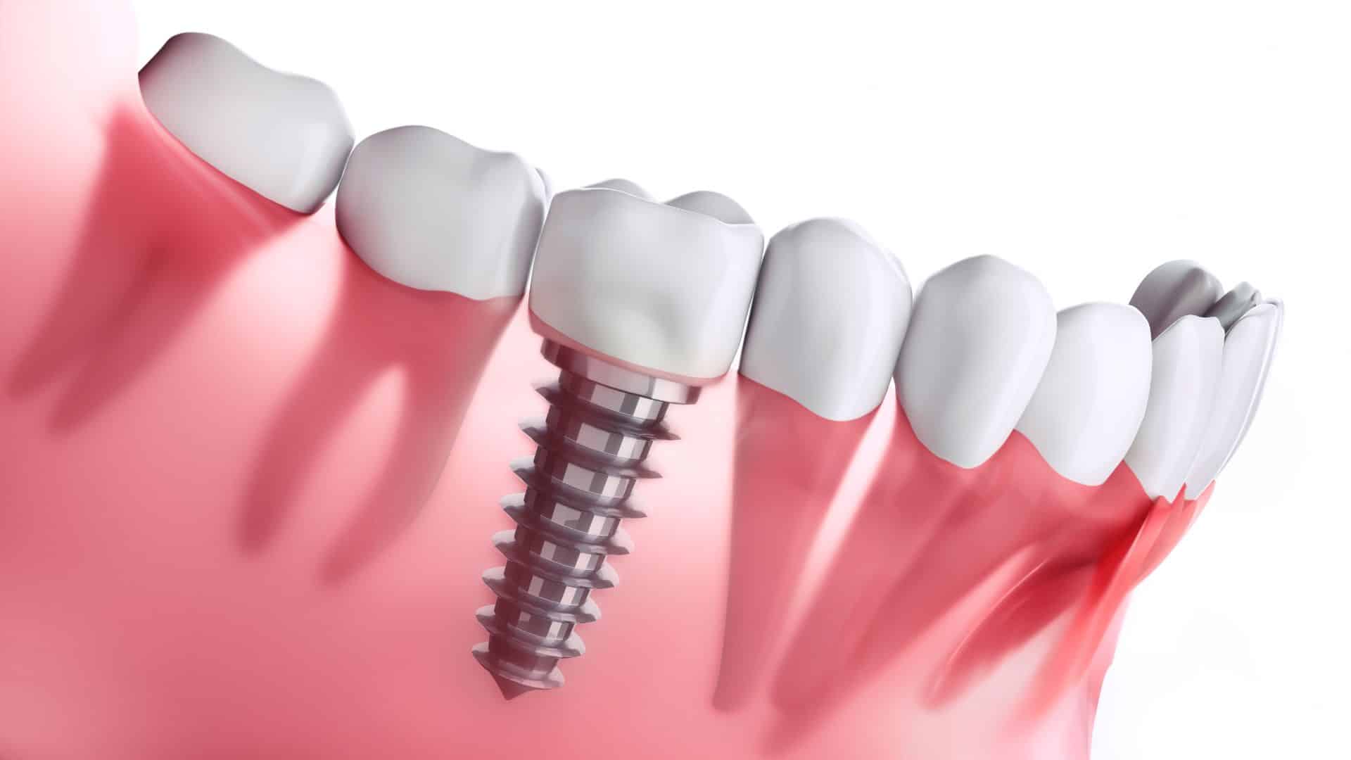 Dental Implants/Implants